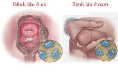 Chi phí xét nghiệm và điều trị bệnh lậu hiện nay