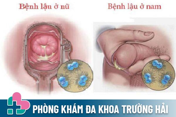 Tong-quan-benh-lau