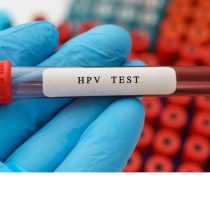 Xet-nghiem-sui-mao-ga-the-nao