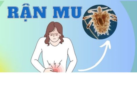 Cách điều trị rận mu hiệu quả nhanh chóng