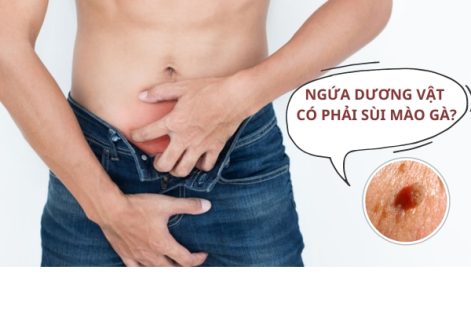 Ngứa dương vật có phải sùi mào gà?