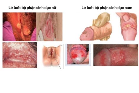 Lỡ loét bộ phận sinh dục là bị bệnh gì?