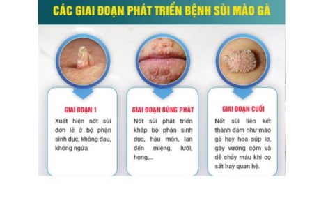 Sùi mào gà – căn bệnh dễ lây nhưng khó điều trị