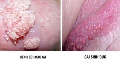 Cách phân biệt sùi mào gà và gai sinh dục dễ dàng