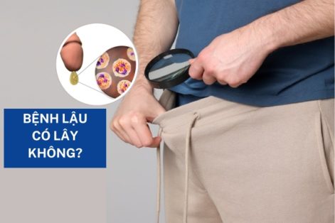 Bệnh lậu có lây không và lây qua đường nào ?