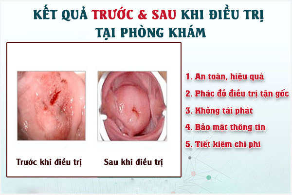 Ket-qua-dieu-tri-ngua-am-dao