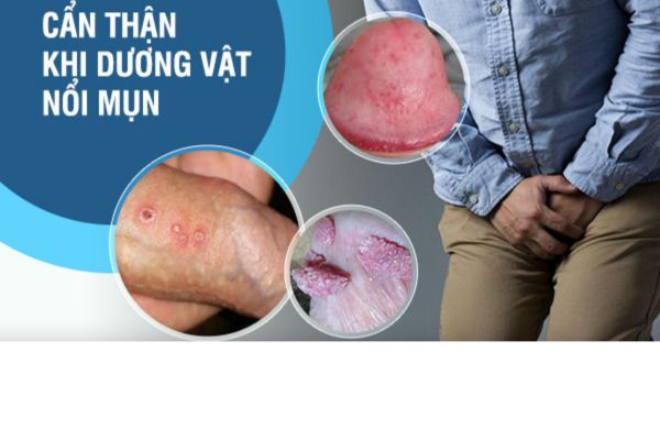 Mun-duong-vat-1