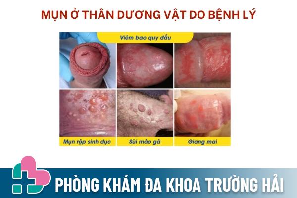 Nguyen-nhan-noi-mun-o-than-duong-vat