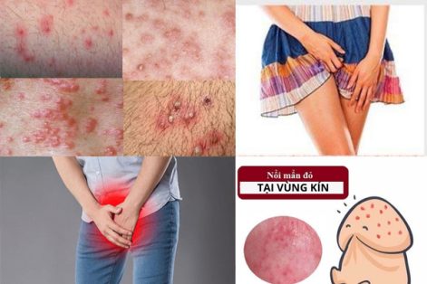 Nổi mụn đỏ tại vùng kín là bị gì ?