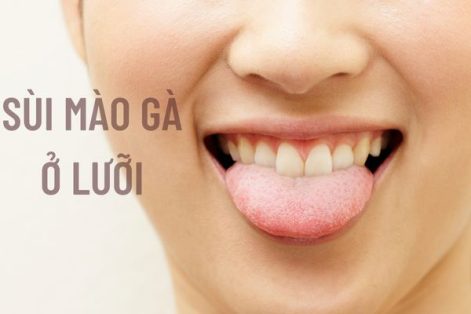 Sùi mào gà ở lưỡi và cách điều trị hiệu quả