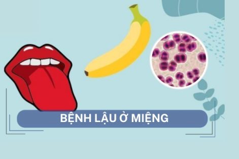 Bệnh lậu ở miệng nguyên nhân dấu hiệu và cách điều trị