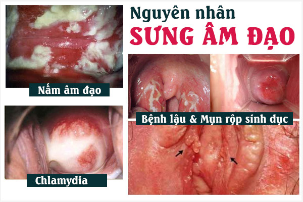 Nguyen-nhan-sung-am-dao