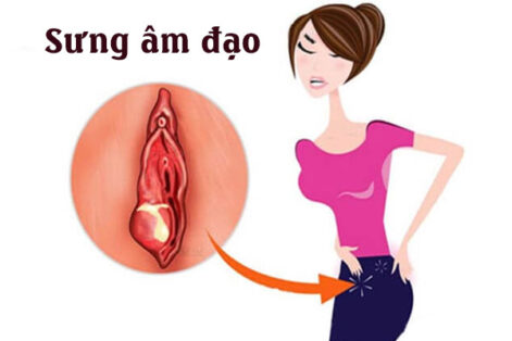 Sưng âm đạo là bệnh gì?
