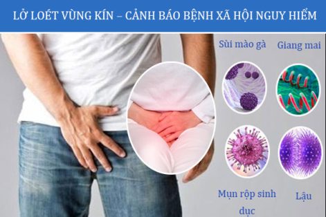 Bị lở loét vùng kín – Có thể nam nữ đang mắc bệnh xã hội mà chưa biết!