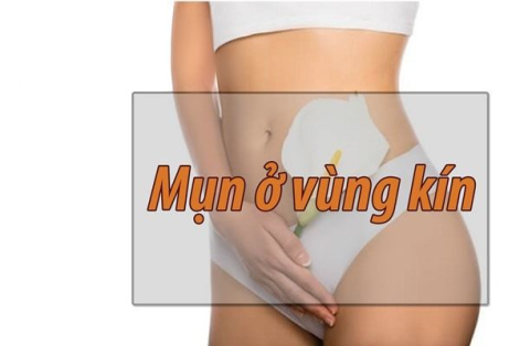 Nổi mụn mủ vùng kín: Nguyên nhân, triệu chứng và cách điều trị