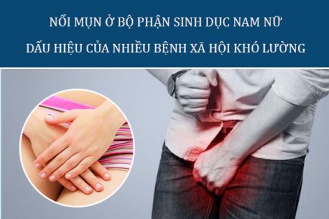 Cẩn trọng: Nổi mụn ở bộ phận sinh dục có thể là bệnh xã hội tiềm ẩn!