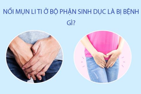 Nổi mụn li ti ở bộ phận sinh dục là bị gì? cách điều trị hiệu quả