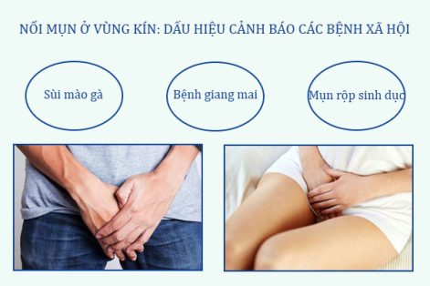 Nổi mụn ở vùng kín: Hé lộ các căn bệnh xã hội nguy hiểm