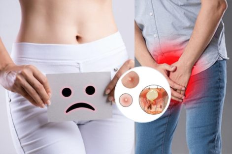 Nổi mụn trắng ở vùng kín có nguy hiểm không bị bệnh gì?