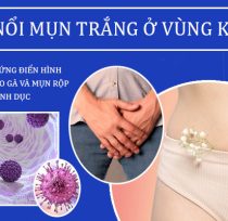 Noi-mun-trang-vung-kin