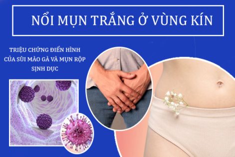 Nổi mụn trắng ở vùng kín: Cẩn thận với những bệnh lý nguy hiểm