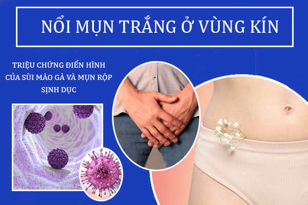 Noi-mun-trang-vung-kin