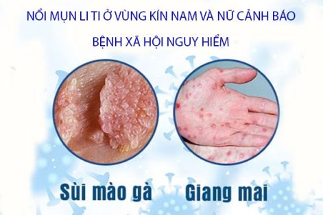 Vùng Kín Nổi Mụn Li Ti: Nguyên Nhân Do Đâu? Khi Nào Cần Đi Khám?
