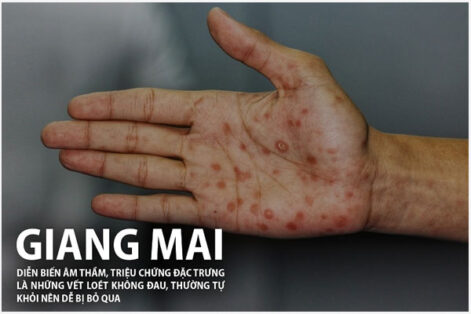 Dấu hiệu & Nguyên nhân mắc bệnh giang mai