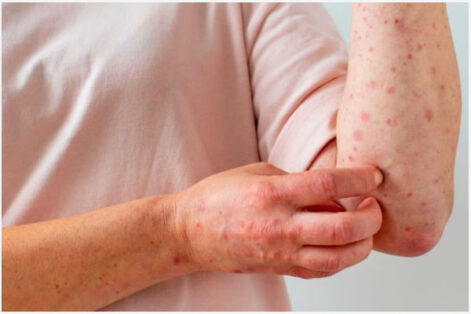 Bệnh giang mai và cách điều trị hiệu quả