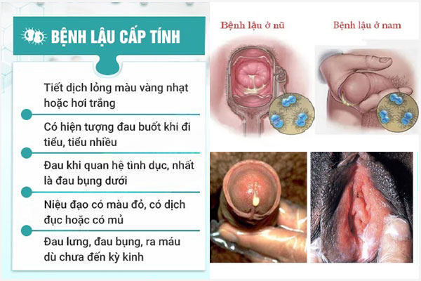 Benh-lau-cap-tinh