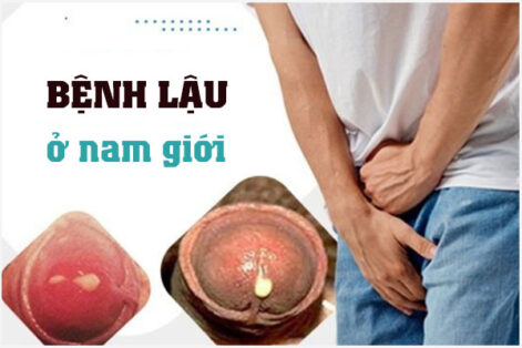 Bệnh lậu ở nam giới: Nguyên nhân – Triệu chứng và Cách chữa