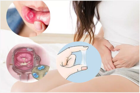 Bệnh lậu ở nữ giới: Nguyên nhân, triệu chứng và cách điều trị hiệu quả