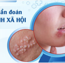 Benh-xa-hoi-o-nu