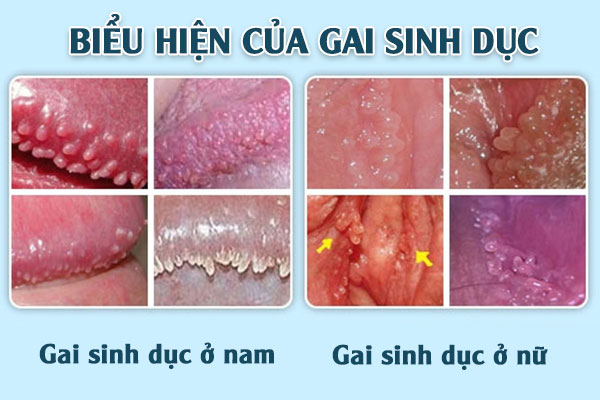 Bieu-hien-gai-sinh-duc
