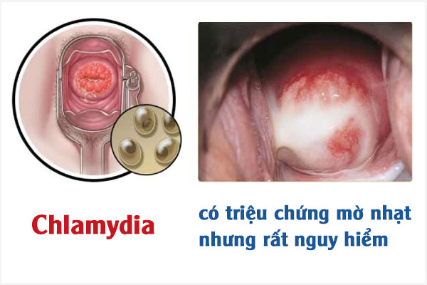 Dau-hieu-chlamydia