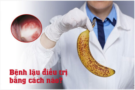 Hỗ trợ điều trị bệnh lậu bằng phương pháp nào là hiệu quả?