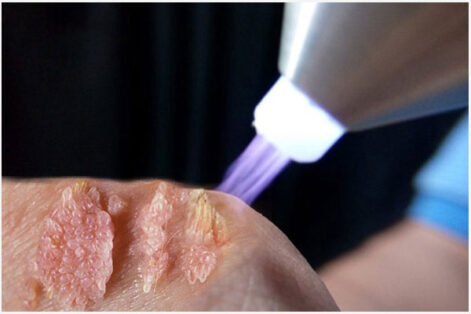 Cách chữa sùi mào gà an toàn hiệu quả