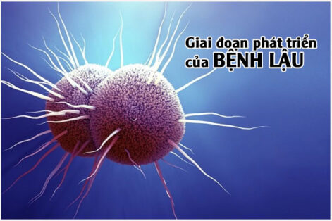 Các giai đoạn của bệnh lậu ở nam và nữ