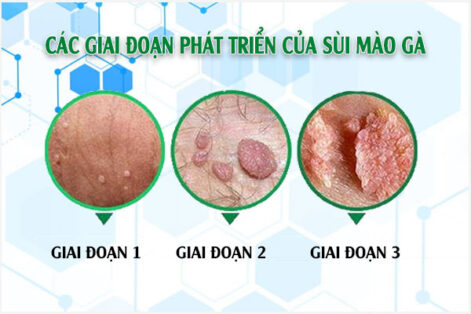 Các giai đoạn sùi mào gà ở nam và nữ
