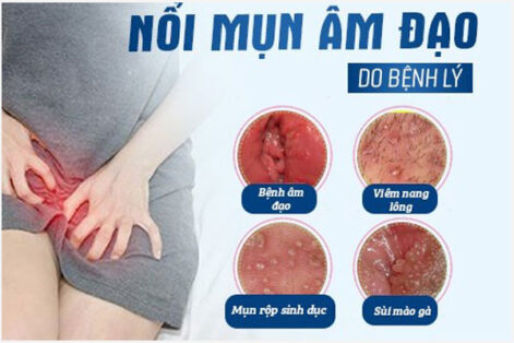 Nổi mụn âm đạo là bị gì? Cách điều trị nhanh chóng?