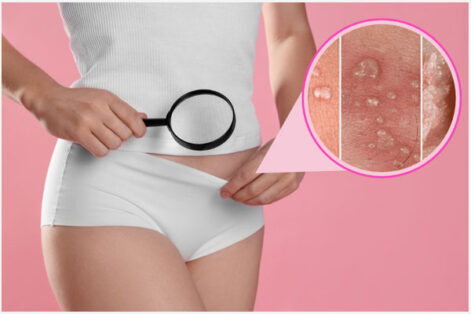 Nổi mụn ở môi bé, môi lớn âm đạo coi chừng mắc bệnh xã hội