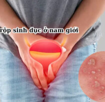 Mun-rop-sinh-duc-o-nam-1