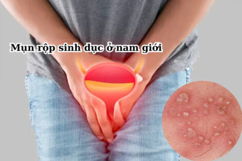 Mụn rộp sinh dục ở nam: Dấu hiệu, Nguy hiểm và Cách khắc phục
