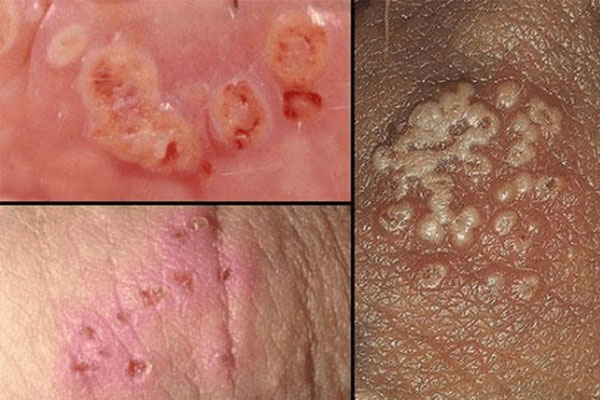 Mun-rop-sinh-duc-o-nam