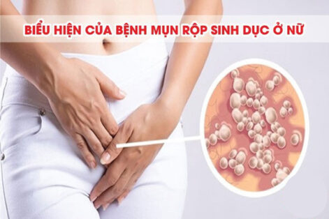 Mụn rộp sinh dục ở nữ: Dấu hiệu, Nguy hiểm và Cách khắc phục