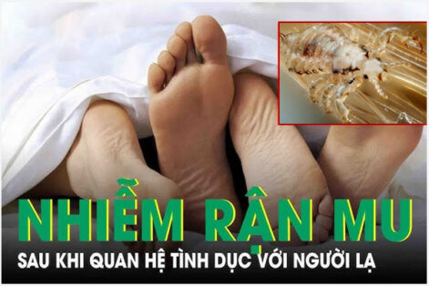 Tổng quan bệnh rận mu ở nam và nữ giới