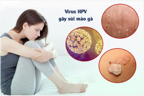 Dấu hiệu nhận biết sùi mào gà ở nam và nữ