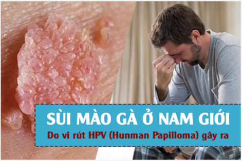 Sùi mào gà ở nam giới: Triệu chứng, Nguy hiểm, Cách khắc phục hiệu quả
