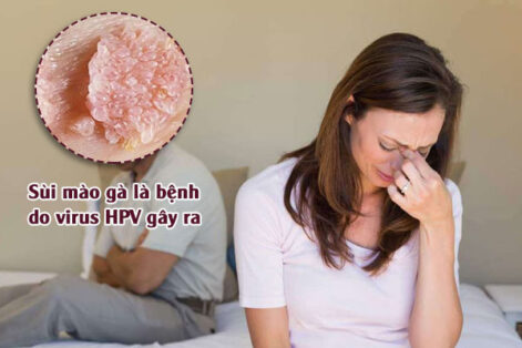 Sùi mào gà ở nữ giới: Triệu chứng, Nguy hiểm, Cách khắc phục hiệu quả