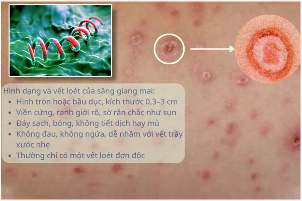 Benh-giang-mai-la-gi